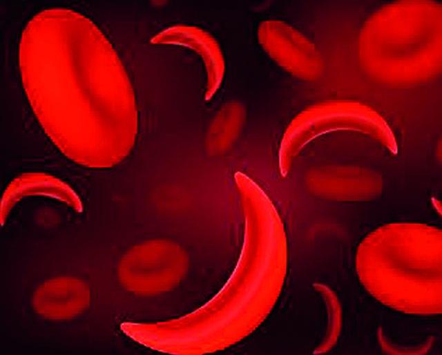There is still little awareness about the Sickleleas | सिकलसेलबाबत अजूनही फारशी जागृती नाही