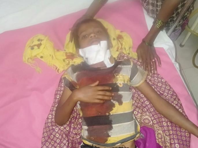 Attack on the child again by the chewed leopard | चवताळलेल्या बिबट्याकडून पुन्हा मुलावर हल्ला Attack on the child again by the chewed leopard | चवताळलेल्या बिबट्याकडून पुन्हा मुलावर हल्ला