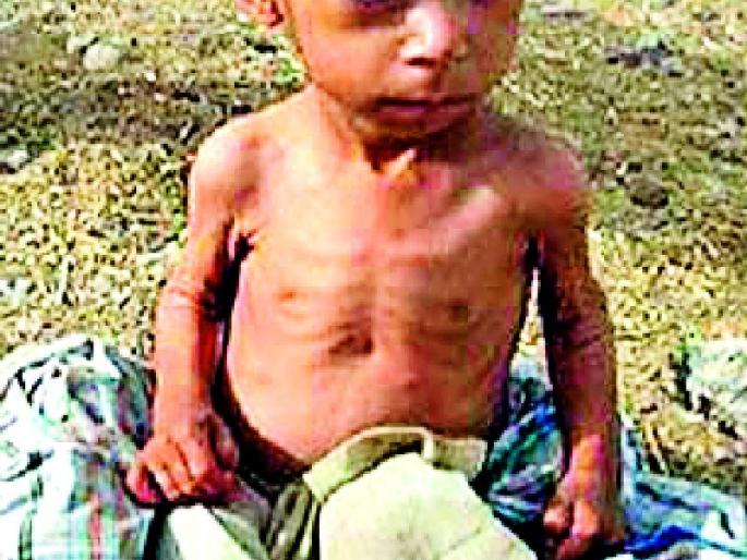 In the district 228 children are severely malnourished | जिल्ह्यात २२८ बालके तीव्र कुपोषित In the district 228 children are severely malnourished | जिल्ह्यात २२८ बालके तीव्र कुपोषित