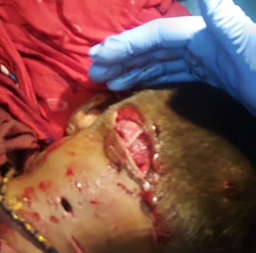 Leopard attacks four-year-old boy | बिबट्याचा चार वर्षीय बालकावर हल्ला Leopard attacks four-year-old boy | बिबट्याचा चार वर्षीय बालकावर हल्ला