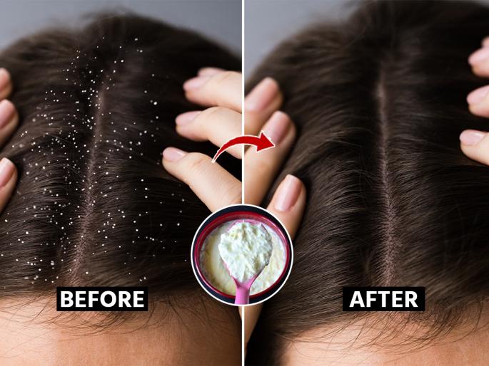 Easy Home remedy for Dandruff Issue by hair stylist jawed habib in winter hair care tips : Javed Habib tells 1 simple solution to reduce dandruff in hair, dandruff will disappear | केसातील कोंडा कमी होण्यासाठी जावेद हबीब सांगतात १ सोपा उपाय, केसातला कोंडा-खाज होईल कमी