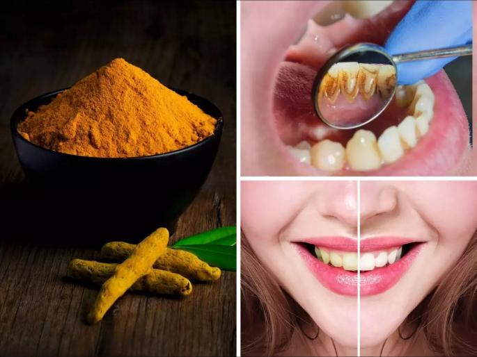 Ayurveda Dr told a effective ayurvedic home remedy to treat toothache yellow teeth | दातांची किड, वेदना आणि काळे कीटक मुळापासून नष्ट करेल हा सोपा आयुर्वेदिक उपाय Ayurveda Dr told a effective ayurvedic home remedy to treat toothache yellow teeth | दातांची किड, वेदना आणि काळे कीटक मुळापासून नष्ट करेल हा सोपा आयुर्वेदिक उपाय