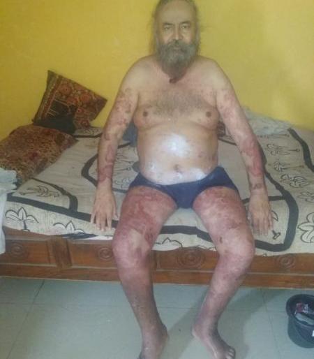 The treatment of the father, who said, 'Hamkhas remedies,' caused blisters all over his body | 'हमखास उपाय करतो' असे सांगितलेल्या बाबाच्या उपचाराने आले अंगभर फोड
