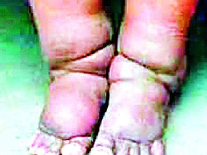 2525 cases of elephantis found in the district last year | मागील वर्षी आढळले जिल्ह्यात हत्तीरोगाचे २५२५ रूग्ण 2525 cases of elephantis found in the district last year | मागील वर्षी आढळले जिल्ह्यात हत्तीरोगाचे २५२५ रूग्ण