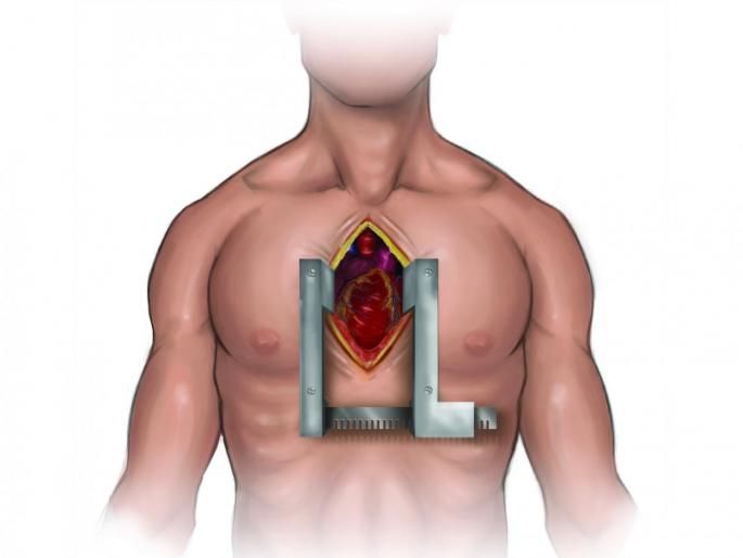 Great! In Nagpur, rare surgery on the heart by stopping blood circulation | ग्रेट! नागपुरात झाली रक्ताभिसरण थांबवून हृदयावर दुर्मिळ शस्त्रक्रिया Great! In Nagpur, rare surgery on the heart by stopping blood circulation | ग्रेट! नागपुरात झाली रक्ताभिसरण थांबवून हृदयावर दुर्मिळ शस्त्रक्रिया