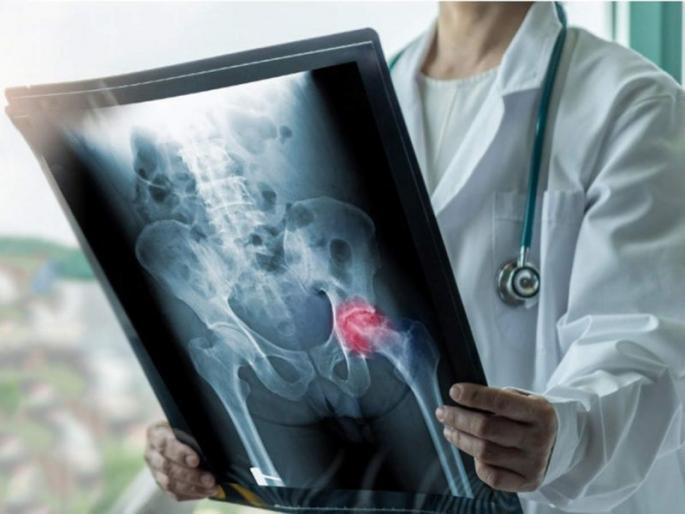 The crisis of ‘Bone Death’ now after ‘Mucker’; Eight patient records | ‘म्युकर’नंतर आता ‘बोन डेथ’चे संकट; आठ रुग्णांची नोंद The crisis of ‘Bone Death’ now after ‘Mucker’; Eight patient records | ‘म्युकर’नंतर आता ‘बोन डेथ’चे संकट; आठ रुग्णांची नोंद