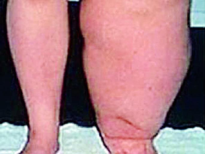 27th in the district of Hepatiroga District Medication Exhibition | २७ पासून हत्तीरोगावर जिल्ह्यात औषधोपचार मोहीम 27th in the district of Hepatiroga District Medication Exhibition | २७ पासून हत्तीरोगावर जिल्ह्यात औषधोपचार मोहीम