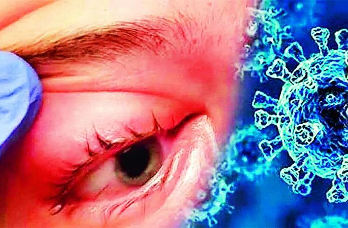 For those with myocardial infarction. Phule Janaarogya Yojana becomes 'Sanjeevani' | म्युकरमायकोसिसग्रस्तांसाठी म. फुले जनआरोग्य योजना ठरली ‘संजीवनी’ For those with myocardial infarction. Phule Janaarogya Yojana becomes 'Sanjeevani' | म्युकरमायकोसिसग्रस्तांसाठी म. फुले जनआरोग्य योजना ठरली ‘संजीवनी’