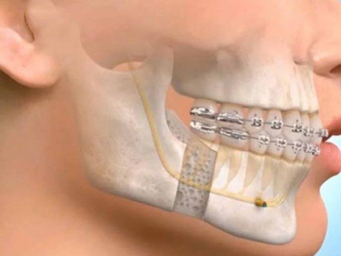 Reconstruction of the jaw after eleven hours of surgery | अकरा तासांच्या शस्त्रक्रियेनंतर जबड्याची पुनर्निर्मिती Reconstruction of the jaw after eleven hours of surgery | अकरा तासांच्या शस्त्रक्रियेनंतर जबड्याची पुनर्निर्मिती