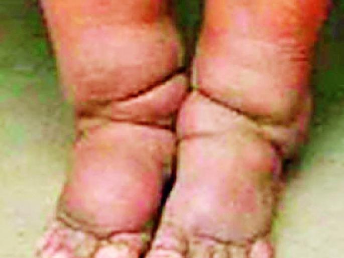 About 172 villages in the district are under the influence of elephant disease | जिल्ह्यातील तब्बल १७२ गावे हत्तीरोगाच्या सावटात About 172 villages in the district are under the influence of elephant disease | जिल्ह्यातील तब्बल १७२ गावे हत्तीरोगाच्या सावटात