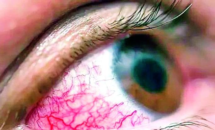 Treatment of myocardial infarction patients through public health scheme | म्युकरमायकाेसिस रुग्णावर जनआराेग्य याेजनेतून उपचार Treatment of myocardial infarction patients through public health scheme | म्युकरमायकाेसिस रुग्णावर जनआराेग्य याेजनेतून उपचार