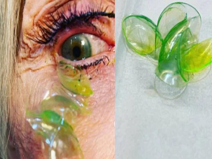 23 contact lenses in womans eye doctor found after she did not remove it any day | डॉक्टरांनी महिलेच्या डोळ्यातील 23 कॉन्टॅक्ट लेन्स काढल्या, पाहा, धक्कादायक व्हिडिओ! 23 contact lenses in womans eye doctor found after she did not remove it any day | डॉक्टरांनी महिलेच्या डोळ्यातील 23 कॉन्टॅक्ट लेन्स काढल्या, पाहा, धक्कादायक व्हिडिओ!