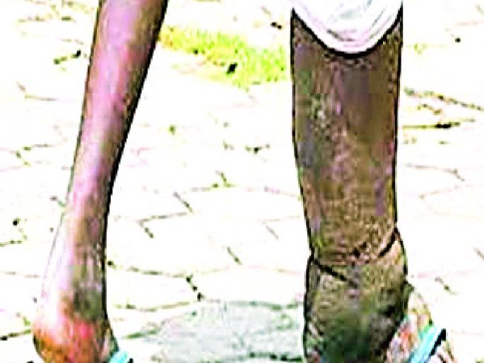 Eleven thousand cases of elephantias | हत्तीपायाचे साडेअकरा हजार रुग्ण Eleven thousand cases of elephantias | हत्तीपायाचे साडेअकरा हजार रुग्ण