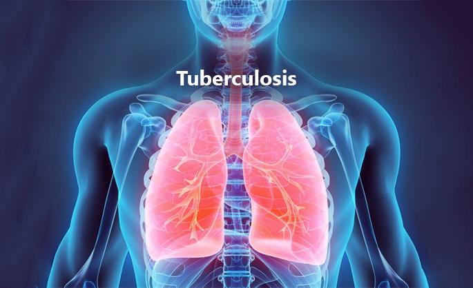Tuberculosis is as deadly as corona, swine flu! | क्षय रोगाचा आजार कोरोना ,स्वाइन फ्ल्यू इतकाच घातक! Tuberculosis is as deadly as corona, swine flu! | क्षय रोगाचा आजार कोरोना ,स्वाइन फ्ल्यू इतकाच घातक!