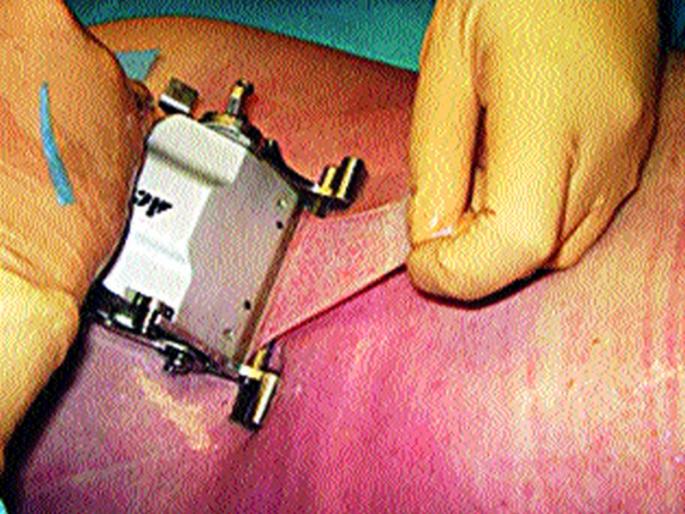 The 'Skin-out' movement in Nashik | नाशकात रुजतेय  ‘त्वचादान’ चळवळ  The 'Skin-out' movement in Nashik | नाशकात रुजतेय  ‘त्वचादान’ चळवळ