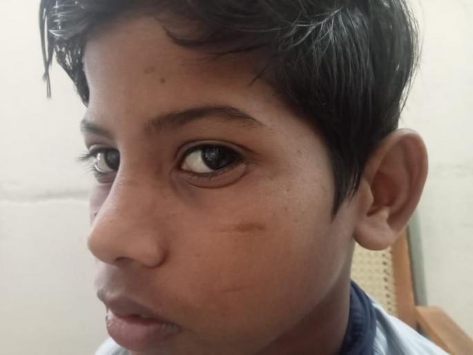 'Why hasn't the ticket been taken yet?' Saying this, the ST conductor beat up the fifth student | 'आतापर्यंत तिकीट का काढले नाही?' असे म्हणत एसटी कंडक्टरची पाचवीतल्या विद्यार्थ्याला मारहाण 'Why hasn't the ticket been taken yet?' Saying this, the ST conductor beat up the fifth student | 'आतापर्यंत तिकीट का काढले नाही?' असे म्हणत एसटी कंडक्टरची पाचवीतल्या विद्यार्थ्याला मारहाण