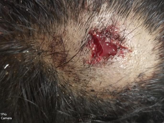 Adult tribal women slab of tribal girls in Kopri; The girl was seriously injured- not a thaw in the administration | कोपरी येथे आदिवासी मुलींच्या वसतीगृहाचा स्लॅब निखळला; मुलगी गंभीर जखमी- प्रशासनास थांगपत्ता नाही Adult tribal women slab of tribal girls in Kopri; The girl was seriously injured- not a thaw in the administration | कोपरी येथे आदिवासी मुलींच्या वसतीगृहाचा स्लॅब निखळला; मुलगी गंभीर जखमी- प्रशासनास थांगपत्ता नाही