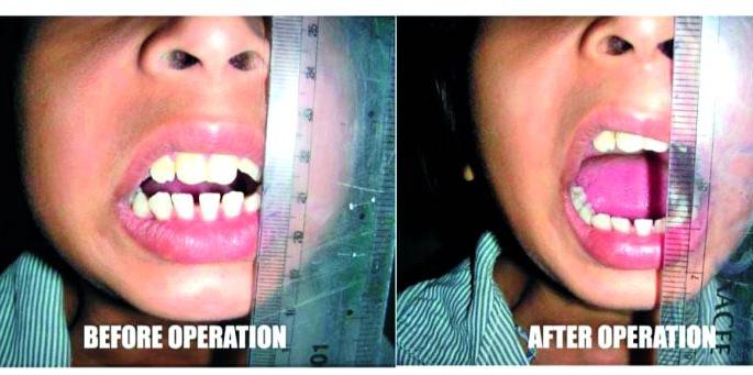 The first jaw joint made in India received a patent; It took 14 years to validate the research | भारतात तयार झालेल्या जबड्याच्या पहिल्या जॉईंटला मिळाले पेटंट; संशोधनाच्या मान्यतेस लागली १४ वर्षे The first jaw joint made in India received a patent; It took 14 years to validate the research | भारतात तयार झालेल्या जबड्याच्या पहिल्या जॉईंटला मिळाले पेटंट; संशोधनाच्या मान्यतेस लागली १४ वर्षे