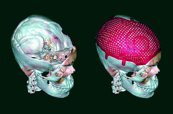 75% of skulls reconstructed for the first time! | पहिल्यांदाच केली कवटीची ७५ टक्के पुुनर्रचना!