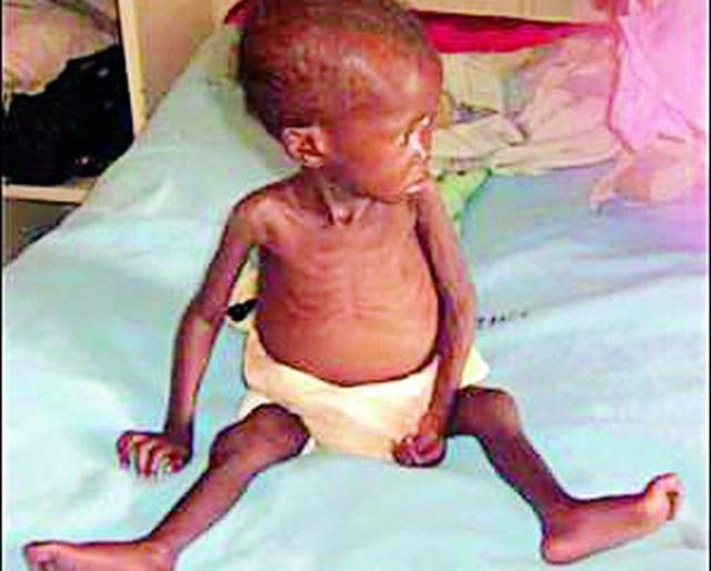 1,641 children in Melghat are severely malnourished | मेळघाटातील १६४१ बालके तीव्र कुपोषित 1,641 children in Melghat are severely malnourished | मेळघाटातील १६४१ बालके तीव्र कुपोषित