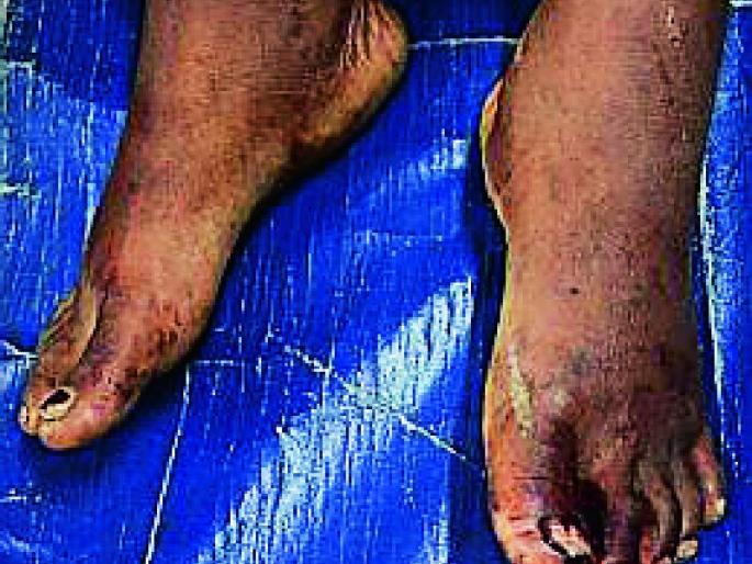 The tubelight was blown on the initiation | दीक्षाच्या अंगावर फोडले होते ट्यूबलाईट The tubelight was blown on the initiation | दीक्षाच्या अंगावर फोडले होते ट्यूबलाईट