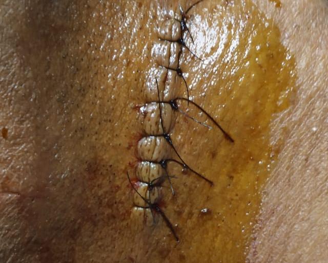 Poultry businessman cut off nylon | नायलॉन मांजाने कापला पोल्ट्री व्यवसायीकाचा गळा Poultry businessman cut off nylon | नायलॉन मांजाने कापला पोल्ट्री व्यवसायीकाचा गळा