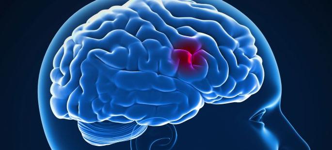 World paralysis day; Increasing paralysis in forties | जागतिक पक्षाघात दिन; चाळिशीत वाढतोय पक्षाघात World paralysis day; Increasing paralysis in forties | जागतिक पक्षाघात दिन; चाळिशीत वाढतोय पक्षाघात