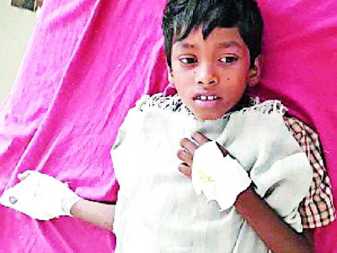The child's hand was taken from the mobile battery | मोबाईलची बॅटरी फुटल्याने बालकाचा भाजला हात The child's hand was taken from the mobile battery | मोबाईलची बॅटरी फुटल्याने बालकाचा भाजला हात