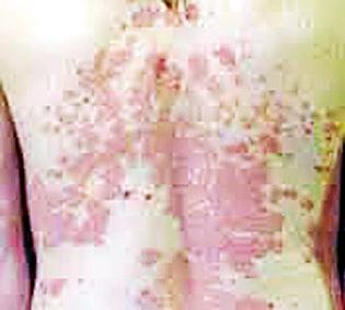 114 leprosy detected during the campaign in the district | जिल्ह्यात मोहिमेदरम्यान आढळले ११४ कुष्ठरुग्ण 114 leprosy detected during the campaign in the district | जिल्ह्यात मोहिमेदरम्यान आढळले ११४ कुष्ठरुग्ण