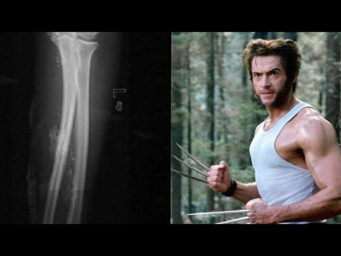 Boy injected himself with mercury in an attempt to become wolverine from the x-men | सुपरहिरो होण्याच्या नादात मुलाने टोचून घेतलं पाऱ्याचं इंजेक्शन आणि मग झालं असं काही.... Boy injected himself with mercury in an attempt to become wolverine from the x-men | सुपरहिरो होण्याच्या नादात मुलाने टोचून घेतलं पाऱ्याचं इंजेक्शन आणि मग झालं असं काही....