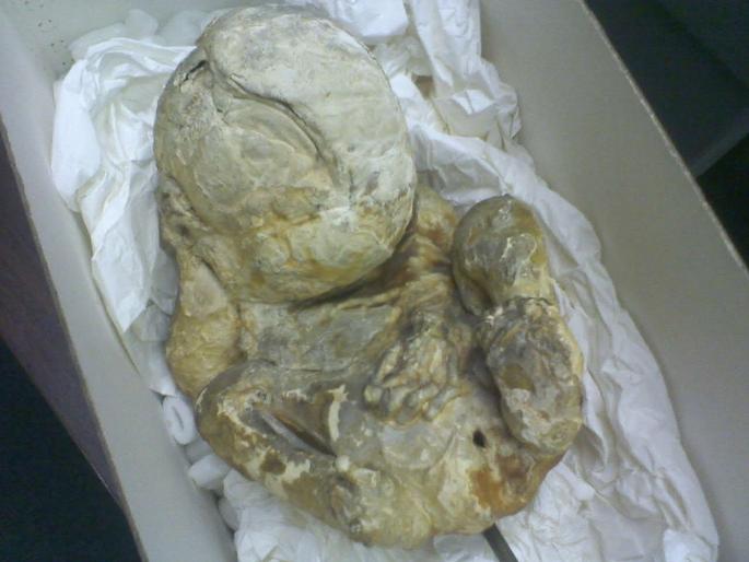 For 15 years 'Stone Baby' stays in the stomach of a woman in Nagpur, | ऐकावे ते नवलच; तब्बल १५ वर्ष नागपुरातील एका महिलेच्या पोटात राहिला ‘स्टोन बेबी’ For 15 years 'Stone Baby' stays in the stomach of a woman in Nagpur, | ऐकावे ते नवलच; तब्बल १५ वर्ष नागपुरातील एका महिलेच्या पोटात राहिला ‘स्टोन बेबी’