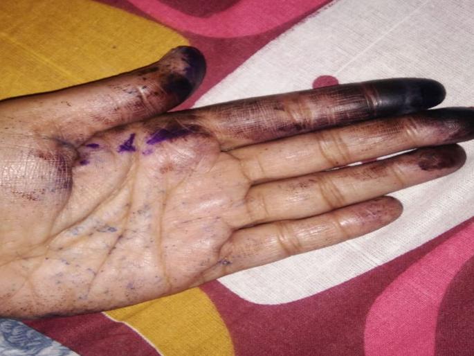 The ink bottleneck resulted in the staffing of the polling booths | शाईची बाधा झाल्याने मतदान केंद्रातील कर्मचाऱ्यांची बोटे सुजली The ink bottleneck resulted in the staffing of the polling booths | शाईची बाधा झाल्याने मतदान केंद्रातील कर्मचाऱ्यांची बोटे सुजली