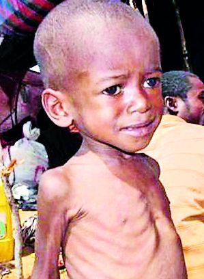 112 infants severely malnourished | ११२ बालके अतितीव्र कुपोषित 112 infants severely malnourished | ११२ बालके अतितीव्र कुपोषित