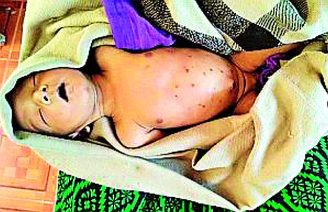 The death of the child with the beeswax | सळईच्या चटक्यांनी बाळाचा मृत्यू