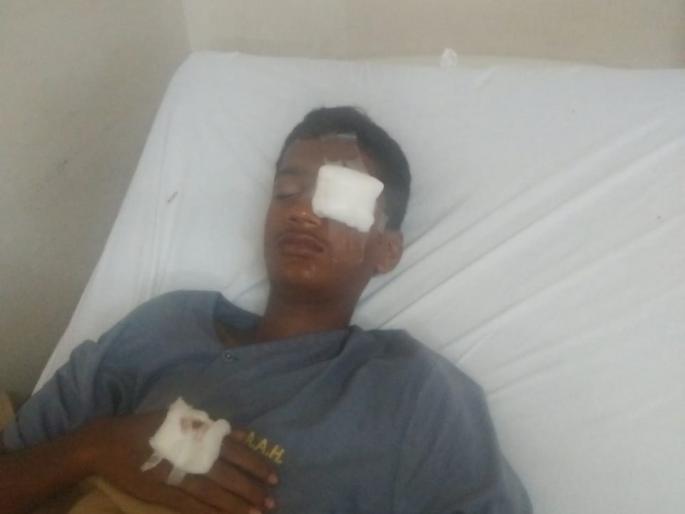 The explosion of the mobile while playing the game | गेम खेळताना मोबाईलचा स्फोट, तरुणाचा डोळा निकामी The explosion of the mobile while playing the game | गेम खेळताना मोबाईलचा स्फोट, तरुणाचा डोळा निकामी