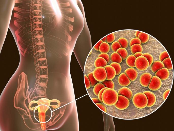 Gonorrhoea Bacterial Infection in Women Sexual transmitted Disease : Have to urinate frequently, burning while doing it - Don't ignore | सतत लघवीला लागले, आग-जळजळ होते? लघवीचे आजार कशाने होतात, टाळायचे कसे?