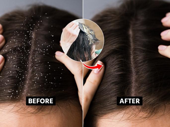 Home Remedy For Dandruff Problem : Dandruff in the hair does not decrease? 1 simple solution, dandruff will be reduced, hair will also remain strong | केसातला कोंडा काही केल्या कमीच होत नाही? १ सोपा उपाय, कोंडा तर कमी होईलच, केसही राहतील मजबूत
