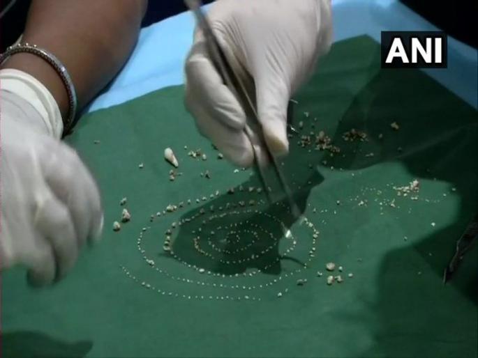 526 Teeth Extracted From 7-Year-Old's Mouth By Chennai Doctors | बापरे! सात वर्षाच्या मुलाच्या तोंडातून काढले 526 दात 526 Teeth Extracted From 7-Year-Old's Mouth By Chennai Doctors | बापरे! सात वर्षाच्या मुलाच्या तोंडातून काढले 526 दात