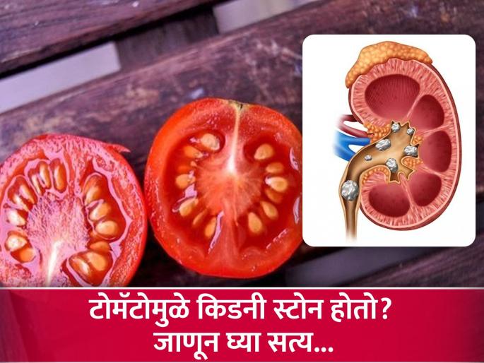 Can eating tomatoes cause kidney stones? Know The truth | टोमॅटो खाल्ल्याने खरंच किडनी स्टोन होतो का? वाता कितपत आहे यात तथ्य Can eating tomatoes cause kidney stones? Know The truth | टोमॅटो खाल्ल्याने खरंच किडनी स्टोन होतो का? वाता कितपत आहे यात तथ्य