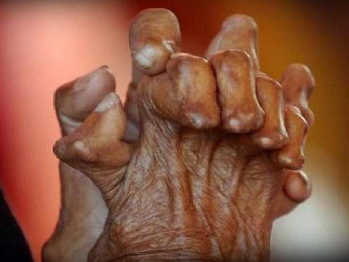 Palghar district ranks second in the state in the number of leprosy patients | कुष्ठरोगाच्या रुग्णसंख्येत पालघर जिल्हा राज्यात दुसऱ्या क्रमांकावर Palghar district ranks second in the state in the number of leprosy patients | कुष्ठरोगाच्या रुग्णसंख्येत पालघर जिल्हा राज्यात दुसऱ्या क्रमांकावर