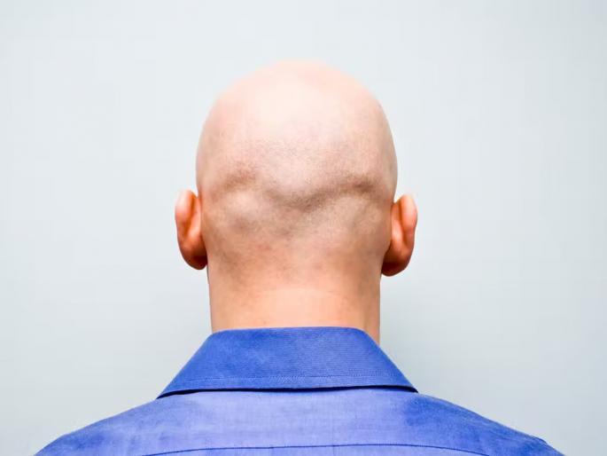 Calling A Man Bald is Crime: Calling man ‘bald’ is sexual harassment, Britain employment tribunal rules | Calling A Man Bald is Crime : खबरदार! टक्कलवरून कोणाला काही बोलाल तर...ते लैंगिक शोषण ठरते; ब्रिटनच्या न्यायालयाचा निर्णय Calling A Man Bald is Crime: Calling man ‘bald’ is sexual harassment, Britain employment tribunal rules | Calling A Man Bald is Crime : खबरदार! टक्कलवरून कोणाला काही बोलाल तर...ते लैंगिक शोषण ठरते; ब्रिटनच्या न्यायालयाचा निर्णय