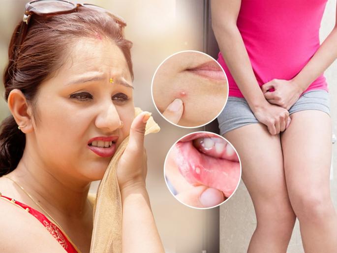 Summer Care Diet Tips : Mouth, burning eyes, summer? 3 Remedies to keep summer woes at bay... | उकाडा वाढल्याने तोंड आलं, डोळ्यांची जळजळ, उन्हाळी लागते? ३ उपाय, उन्हाचे त्रास होतील कमी