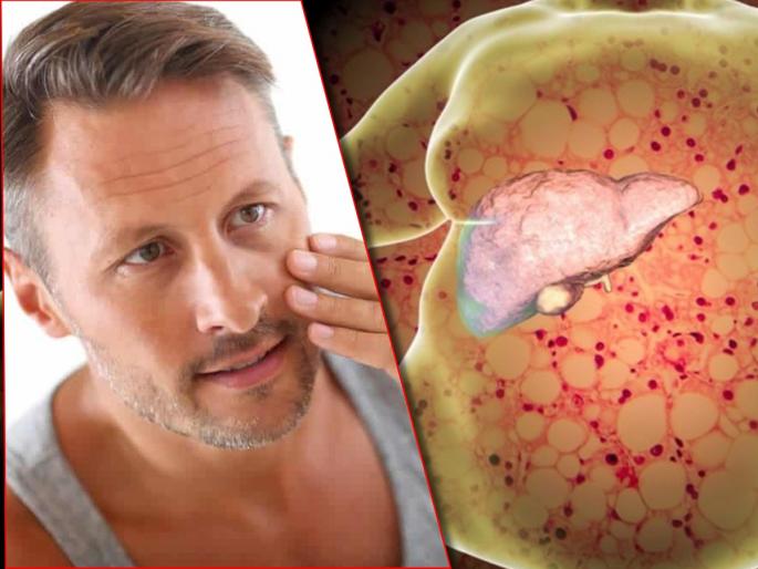 World liver day : Sign and symptoms of fatty liver diseases you can see on your face | World Liver Day : तोंडावर दिसणारी ही लक्षणं सांगतात तुमचं लिव्हर झालंय खराब, दुर्लक्ष करणं पडू शकतं महागात World liver day : Sign and symptoms of fatty liver diseases you can see on your face | World Liver Day : तोंडावर दिसणारी ही लक्षणं सांगतात तुमचं लिव्हर झालंय खराब, दुर्लक्ष करणं पडू शकतं महागात