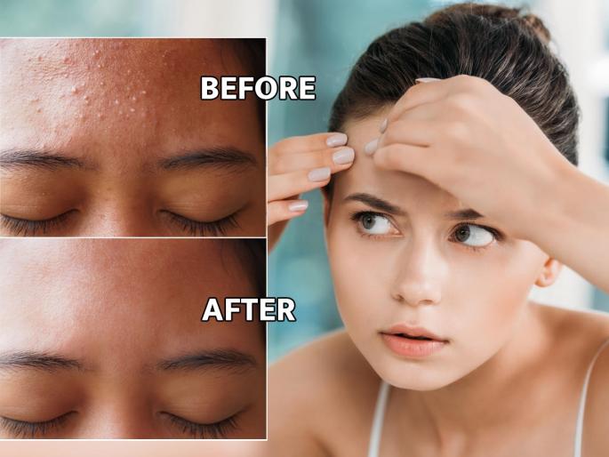Skin Care Home Remedies for forehead Bumps : Do you also get a constant rash on your forehead? 4 simple solutions, acne will be less | तुम्हालाही कपाळावर सतत बारीक पुरळ येते का? 4 सोपे उपाय, पुरळ होईल कमी
