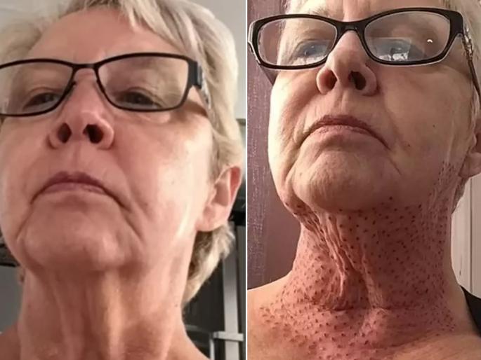 Skin tightening treatments ; The woman's neck was literally like Lizard | स्कीन टाइटनिंग ट्रिटमेंट पडली महागात; महिलेची मान झाली अक्षरश: पालीसारखी...
