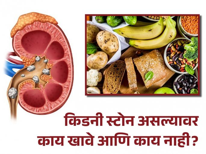 What to eat or not in kidney stone? you should know | किडनी स्टोन असल्यावर काय खावे-प्यावे किंवा काय खाणं टाळावे? What to eat or not in kidney stone? you should know | किडनी स्टोन असल्यावर काय खावे-प्यावे किंवा काय खाणं टाळावे?