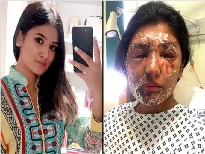 The acid attack brought her a handsome face, the face of the idol was made in three months | अॅसिड हल्ल्याचा तिने केला देखणा मुकाबला, विद्रूप चेहरा तीन महिन्यात बनला ईद का चाँद The acid attack brought her a handsome face, the face of the idol was made in three months | अॅसिड हल्ल्याचा तिने केला देखणा मुकाबला, विद्रूप चेहरा तीन महिन्यात बनला ईद का चाँद