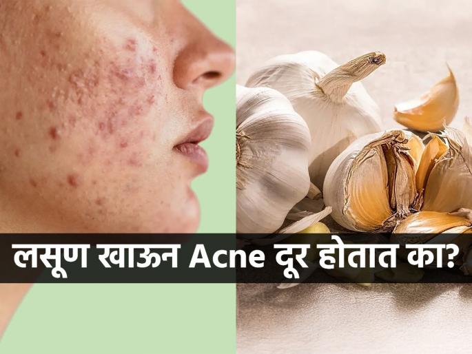 Can consuming garlic every morning remove acne? know what skin expert says | उपाशीपोटी कच्चा लसूण खाल्ल्यानं चेहऱ्यावरची पुरळ-ॲक्ने कमी होतात? व्हायरल चर्चा, पाहा तज्ज्ञ काय म्हणतात..
