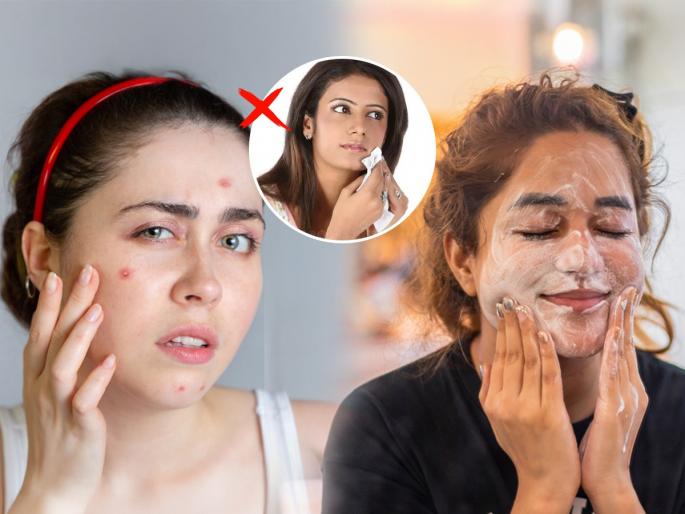 pimples and acne on your face Monsoon skin care tips simple home remedies | चेहऱ्यावर अचानक मुरुमं-पुटकुळ्या वाढल्या? पावसाळ्यातला हा त्रास कमी करण्यासाठी 'अशी' घ्या काळजी
