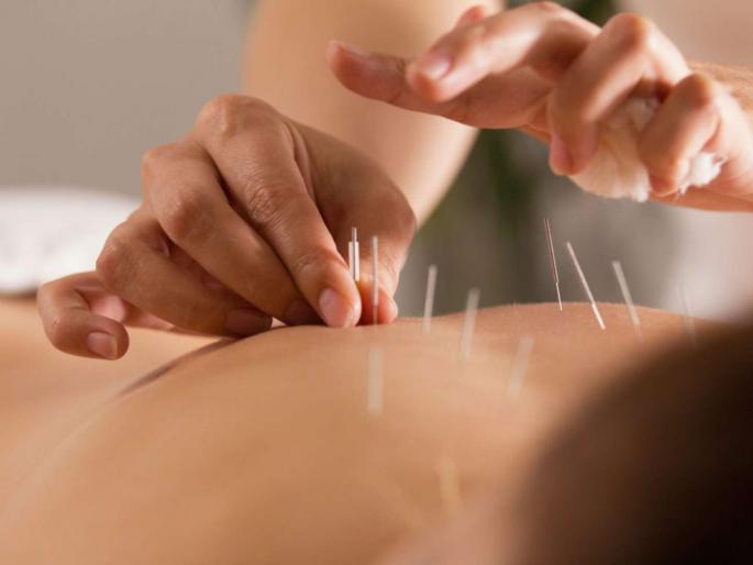 Center recognition of acupuncture | अॅक्युपंक्चरला केंद्राची मान्यता Center recognition of acupuncture | अॅक्युपंक्चरला केंद्राची मान्यता